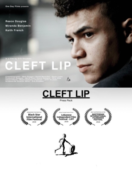 Cleft Lip